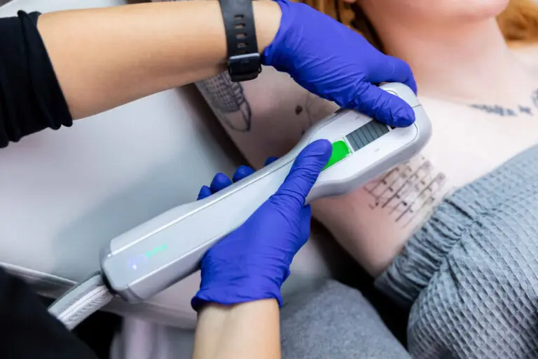 Close-up of a patient's armpit during a session for miraDry near High Point, NC