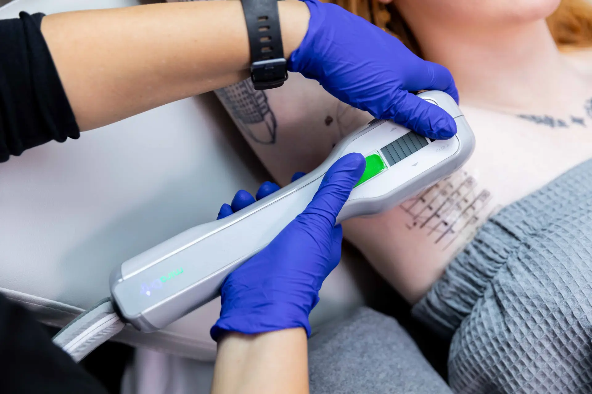 Close-up of a patient's armpit during a session for miraDry near High Point, NC