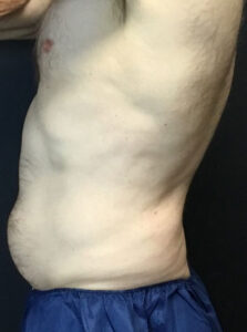 Coolsculpting Elite Abdomen Male - Restoration Medspa