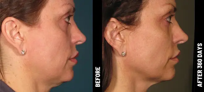 CRANK THE COLLAGEN WITH ULTHERAPY