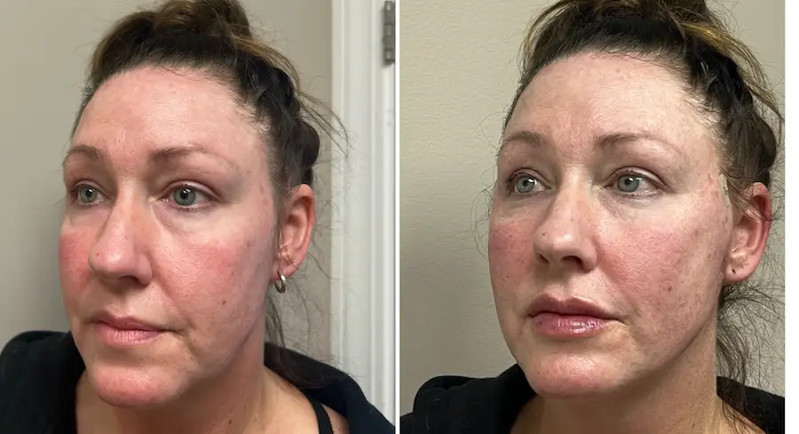 A before-and-after set of photos of a female client before and after a PDO thread appointment. This option for facial balancing in Greensboro lifts the skin for enhanced facial harmony.