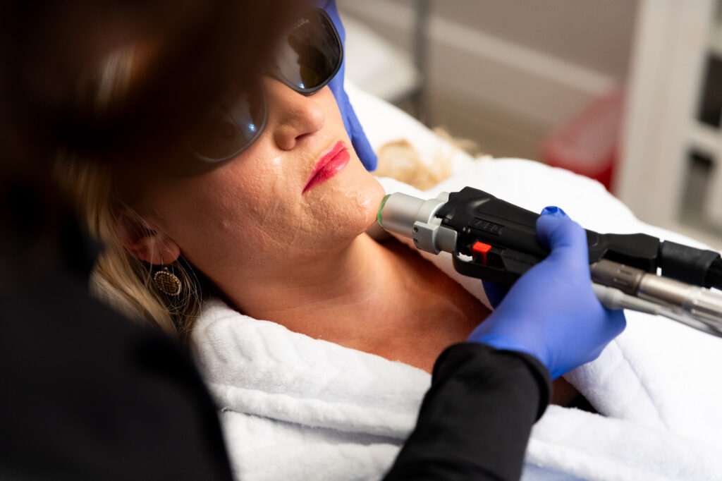 A patient lies down with protective eyewear over her eyes as a Restoration MedSpa uses laser hair removal near Summerfield to target unwanted hair under her chin.