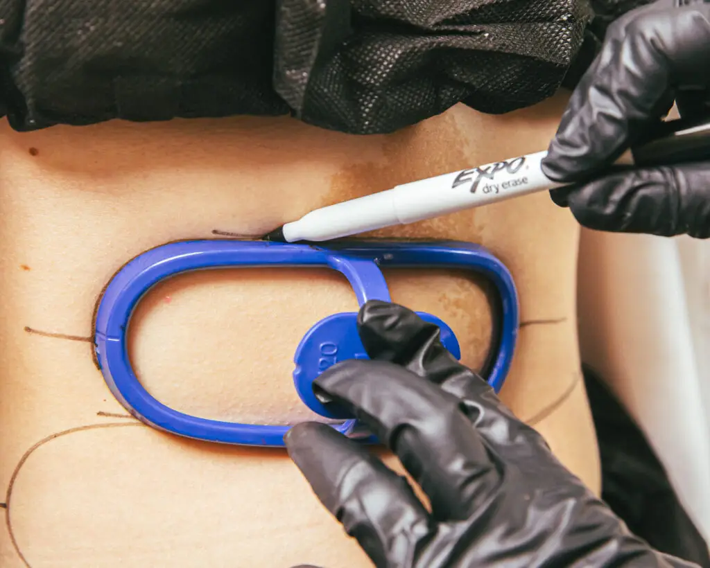 A Restoration MedSpa provider, wearing black gloves, marks targeted fat pockets with a dark blue guide and a black Expo marker, preparing the client for CoolSculpting Elite. This option for body contouring near Summerfield minimizes fat for a slimmer stomach.